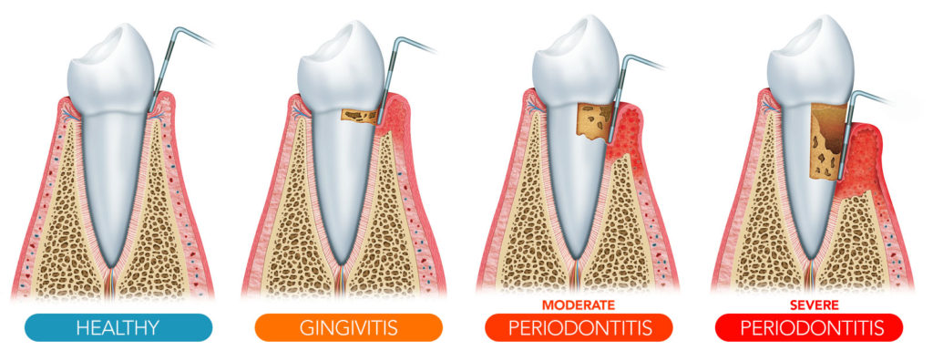 stages of gum disease South Miami, FL