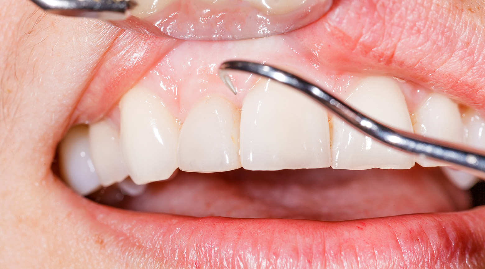 Gingivectomy treatment, South Miami FL