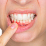 Gum Disease and Treatments