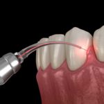 laser used to treat periodontal disease