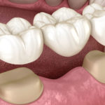 How a Dental Bridge Fits In Your Mouth