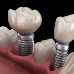 Dental Implants in Your Mouth