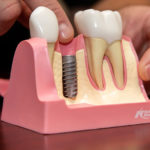Dental Implant In Bone, Model