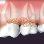 a diagram depicting the effects of gum disease