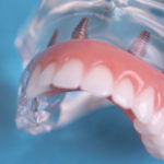 Full Arch Dental Implant Model