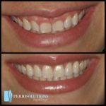 Esthetic Crown Lengthening - Before & After