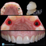 Dental implant before and after