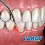 Example of LANAP procedure