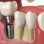 Rendering of healthy teeth and a dental implant