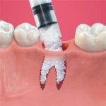 Tooth Extraction and fill